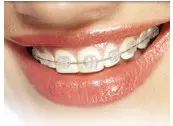 Ceramic Braces