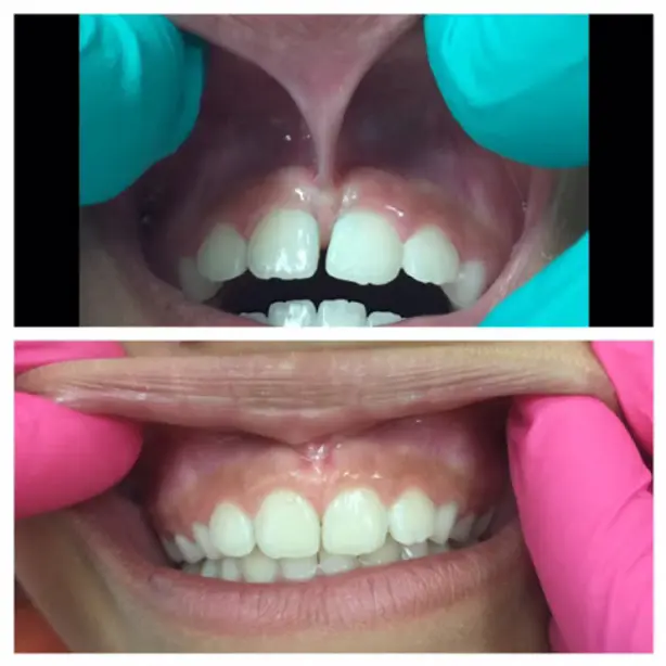 Before and after of a frenectomy