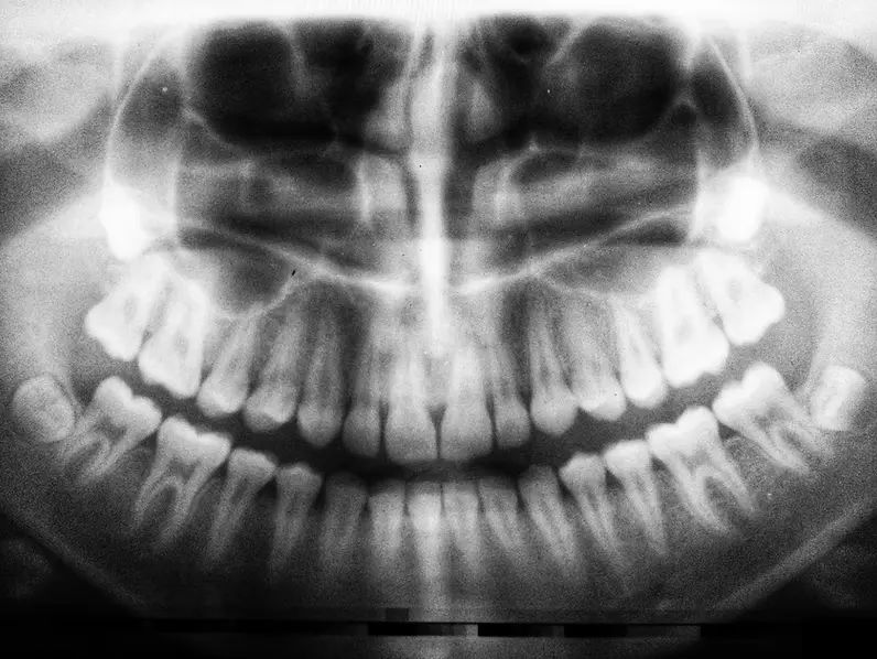 img-surgical X-Ray of mouth including teeth and jawbones
